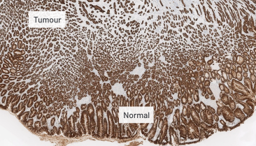 Normal and tumour cell CLDN18.2 staining at 5x magnification