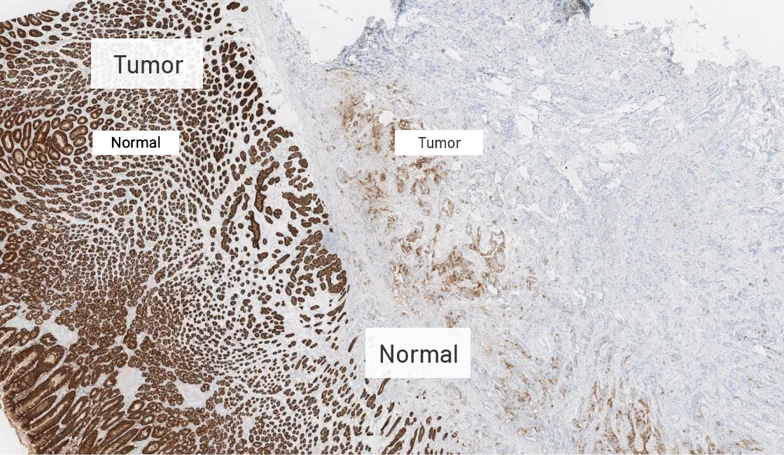 Normal and tumor cell CLDN18.2 staining at 2x magnification 
